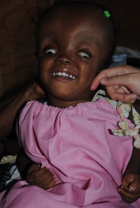 Phlamanda little girl with hydrocephalus